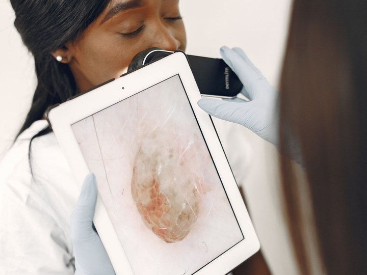 Exame de pinta com dermatoscópio